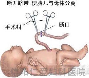 剖腹产全过程（图解）