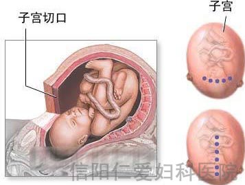 剖腹产全过程（图解）