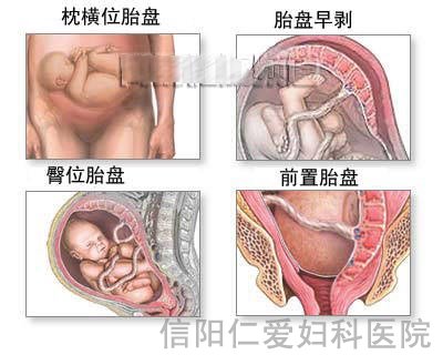 剖腹产全过程（图解）