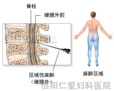 剖腹产全过程（图解）