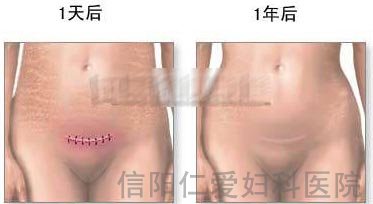 剖腹产全过程（图解）