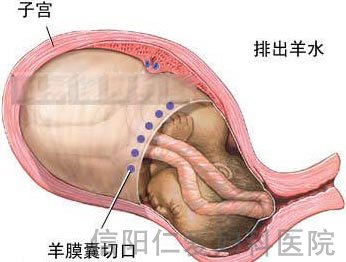 剖腹产全过程（图解）