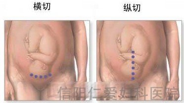 剖腹产全过程（图解）