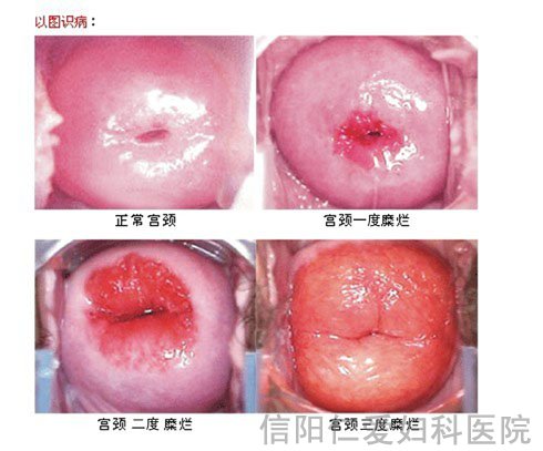 宫颈糜烂女性不可不知的常识