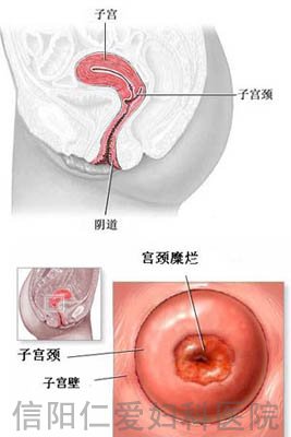 切勿陷入治疗宫颈糜烂的误区