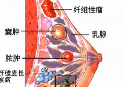 乳腺囊肿是怎么回事？