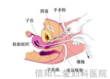 无痛人流全过程是怎样的？